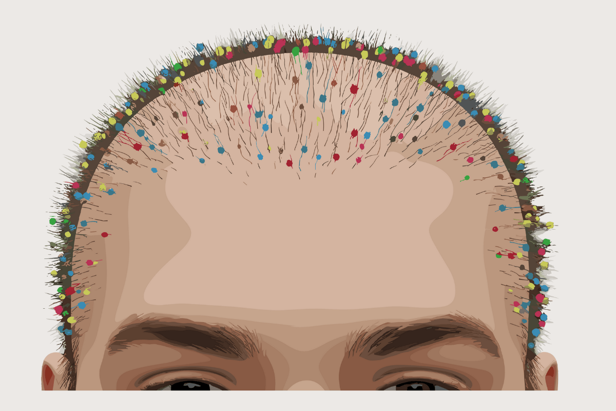 Tại sao nang tóc biến mất và chân tóc bị teo