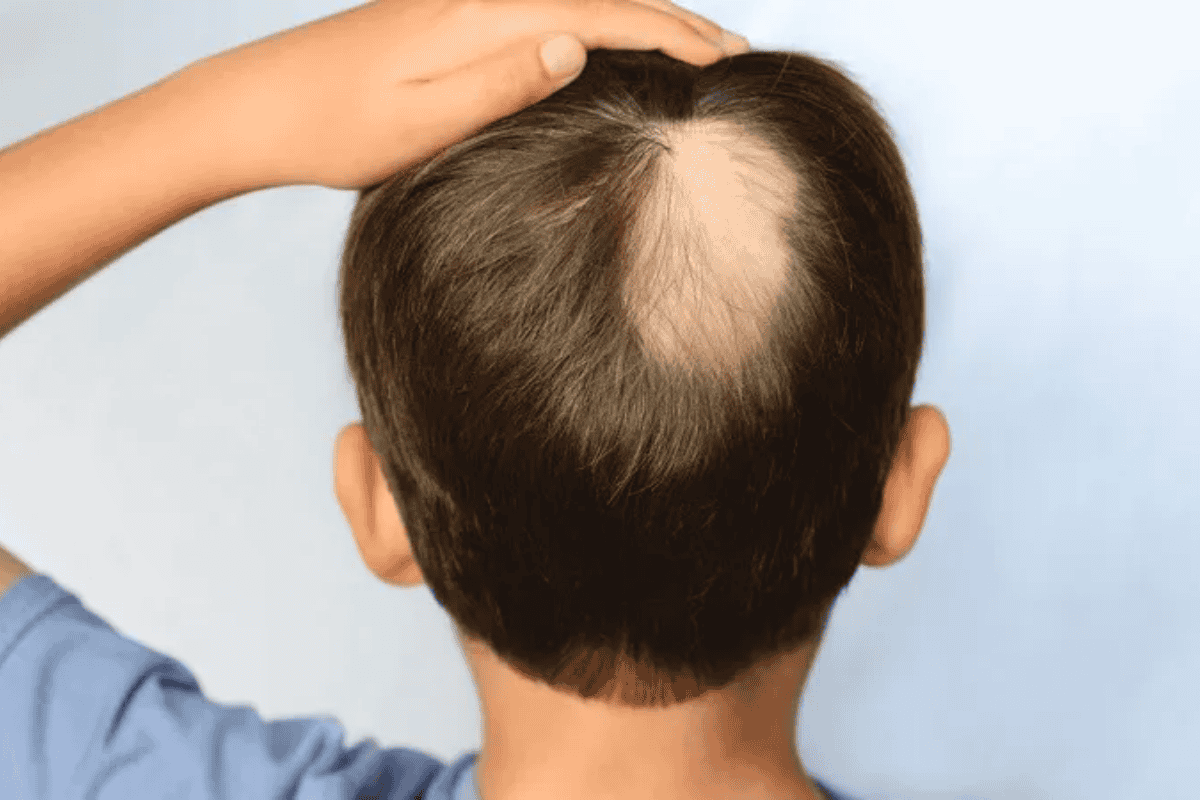 Trẻ bị rụng tóc là thiếu chất gì